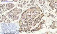 Immunohistochemistry of paraffin-embedded Human stomach cancer tissue using CD284 Polyclonal Antibody at dilution of 1:200.