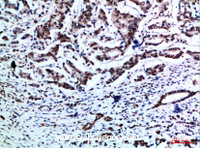 Immunohistochemistry of paraffin-embedded Human breast cancer tissue using Vimentin Polyclonal Antibody at dilution of 1:200.