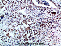 Immunohistochemistry of paraffin-embedded Human breast cancer tissue using Vimentin Polyclonal Antibody at dilution of 1:200.