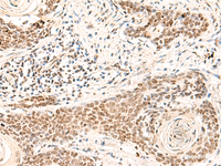 Immunohistochemistry of paraffin-embedded Human esophagus cancer tissue using HOXD9 Polyclonal Antibody at dilution of 1:30 (×200)