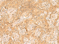 Immunohistochemistry of paraffin-embedded Human ovarian cancer tissue using TRMT112 Polyclonal Antibody at dilution of 1:30 (×200)