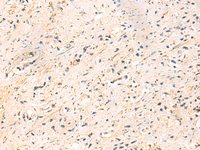 Immunohistochemistry of paraffin-embedded Human prost at e cancer tissue using IP6K3 Polyclonal Antibody at dilution of 1:50 (×200)