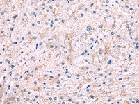 Immunohistochemistry of paraffin-embedded Human liver cancer tissue using IP6K2 Polyclonal Antibody at dilution of 1:50 (×200)