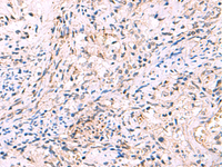 Immunohistochemistry of paraffin-embedded Human cervical cancer tissue using INPP5B Polyclonal Antibody at dilution of 1:40 (×200)