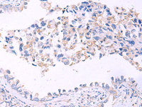 Immunohistochemistry of paraffin-embedded Human lung cancer tissue using GRIA2 Polyclonal Antibody at dilution of 1:40 (×200)