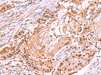 Immunohistochemistry of paraffin-embedded Human esophagus cancer tissue using IRX4 Polyclonal Antibody at dilution of 1:35 (×200)