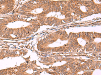 Immunohistochemistry of paraffin-embedded Human colorectal cancer tissue using IST1 Polyclonal Antibody at dilution of 1:40 (×200)