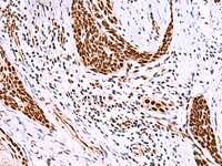 Immunohistochemistry of paraffin-embedded Human esophagus cancer tissue using ISY1-RAB43 Polyclonal Antibody at dilution of 1:30 (×200)