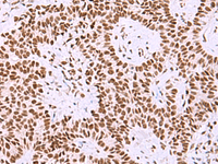 Immunohistochemistry of paraffin-embedded Human ovarian cancer tissue using ISY1-RAB43 Polyclonal Antibody at dilution of 1:30 (×200)