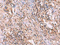 Immunohistochemistry of paraffin-embedded Human cervical cancer tissue using ITIH4 Polyclonal Antibody at dilution of 1:30 (×200)