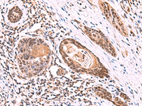Immunohistochemistry of paraffin-embedded Human esophagus cancer tissue using ITPR2 Polyclonal Antibody at dilution of 1:60 (×200)