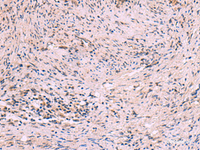 Immunohistochemistry of paraffin-embedded Human cervical cancer tissue using MBTPS2 Polyclonal Antibody at dilution of 1:30 (×200)