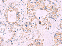 Immunohistochemistry of paraffin-embedded Human gastric cancer tissue using TNF Polyclonal Antibody at dilution of 1:40 (×200)