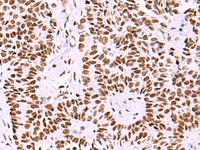 Immunohistochemistry of paraffin-embedded Human ovarian cancer tissue using TRIM28 (phospho-Ser824) Polyclonal Antibody at dilution of 1:30 (×200)