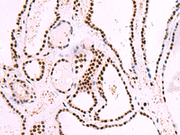 Immunohistochemistry of paraffin-embedded Human thyroid cancer tissue using TRIM28 (phospho-Ser824) Polyclonal Antibody at dilution of 1:30 (×200)