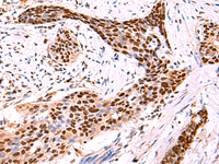 Immunohistochemistry of paraffin-embedded Human esophagus cancer tissue using SOX2 Polyclonal Antibody at dilution of 1:50 (×200)