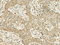 Immunohistochemistry of paraffin-embedded Human ovarian cancer tissue using KAT7 Polyclonal Antibody at dilution of 1:45 (×200)