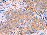 Immunohistochemistry of paraffin-embedded Human cervical cancer tissue using G6PC Polyclonal Antibody at dilution of 1:70 (×200)