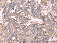 Immunohistochemistry of paraffin-embedded Human liver cancer tissue using KCNN2 Polyclonal Antibody at dilution of 1:30 (×200)