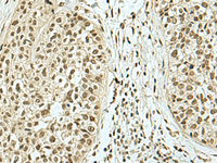 Immunohistochemistry of paraffin-embedded Human esophagus cancer tissue using KHSRP Polyclonal Antibody at dilution of 1:40 (×200)