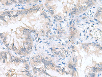 Immunohistochemistry of paraffin-embedded Human lung cancer tissue using CAMSAP3 Polyclonal Antibody at dilution of 1:90 (×200)