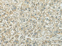 Immunohistochemistry of paraffin-embedded Human liver cancer tissue using KIF21B Polyclonal Antibody at dilution of 1:40 (×200)