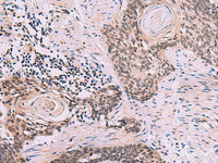 Immunohistochemistry of paraffin-embedded Human esophagus cancer tissue using CDK4 Polyclonal Antibody at dilution of 1:60 (×200)