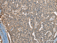 Immunohistochemistry of paraffin-embedded Human liver cancer tissue using COX7A2L Polyclonal Antibody at dilution of 1:30 (×200)
