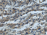 Immunohistochemistry of paraffin-embedded Human liver cancer tissue using CUL5 Polyclonal Antibody at dilution of 1:55 (×200)