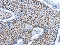 Immunohistochemistry of paraffin-embedded Human lung cancer tissue using GNRH1 Polyclonal Antibody at dilution of 1:70 (×200)