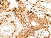Immunohistochemistry of paraffin-embedded Human thyroid cancer tissue using PDCD4 Polyclonal Antibody at dilution of 1:35 (×200)