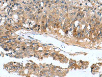 Immunohistochemistry of paraffin-embedded Human liver cancer tissue using PDCD5 Polyclonal Antibody at dilution of 1:105 (×200)