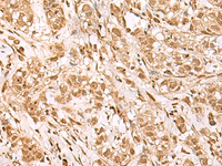 Immunohistochemistry of paraffin-embedded Human breast cancer tissue using BAP1 Polyclonal Antibody at dilution of 1:35 (×200)