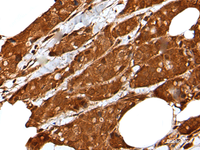 Immunohistochemistry of paraffin-embedded Human breast cancer tissue using LIPG Polyclonal Antibody at dilution of 1:50 (×200)