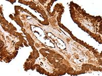 Immunohistochemistry of paraffin-embedded Human thyroid cancer tissue using LAMTOR5 Polyclonal Antibody at dilution of 1:55 (×200)