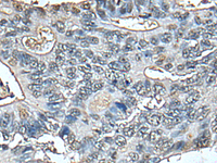 Immunohistochemistry of paraffin-embedded Human colorectal cancer tissue using STRADA Polyclonal Antibody at dilution of 1:85 (×200)