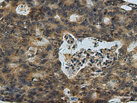 Immunohistochemistry of paraffin-embedded Human colorectal cancer tissue using PLTP Polyclonal Antibody at dilution of 1:60 (×200)