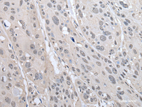 Immunohistochemistry of paraffin-embedded Human esophagus cancer tissue using PRAME Polyclonal Antibody at dilution of 1:65 (×200)