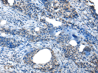 Immunohistochemistry of paraffin-embedded Human cervical cancer tissue using SAA4 Polyclonal Antibody at dilution of 1:35 (×200)