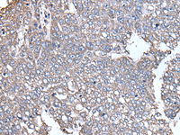 Immunohistochemistry of paraffin-embedded Human liver cancer tissue using SCP2 Polyclonal Antibody at dilution of 1:35 (×200)