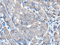 Immunohistochemistry of paraffin-embedded Human breast cancer tissue using HELLS Polyclonal Antibody at dilution of 1:65 (×200)