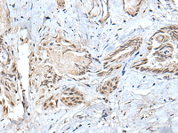 Immunohistochemistry of paraffin-embedded Human thyroid cancer tissue using SMC1A Polyclonal Antibody at dilution of 1:30 (×200)