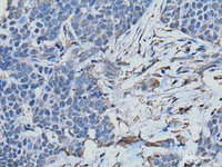 Immunohistochemistry of paraffin-embedded Human thyroid cancer tissue using TPT1 Polyclonal Antibody at dilution of 1:45 (×200)
