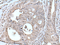 Immunohistochemistry of paraffin-embedded Human colorectal cancer tissue using TPT1 Polyclonal Antibody at dilution of 1:45 (×200)