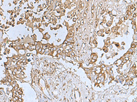 Immunohistochemistry of paraffin-embedded Human colorectal cancer tissue using TREM1 Polyclonal Antibody at dilution of 1:50 (×200)