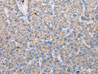 Immunohistochemistry of paraffin-embedded Human liver cancer tissue using FKBPL Polyclonal Antibody at dilution of 1:50 (×200)