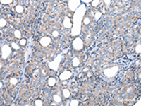 Immunohistochemistry of paraffin-embedded Human thyroid cancer tissue using FKBPL Polyclonal Antibody at dilution of 1:50 (×200)