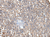 Immunohistochemistry of paraffin-embedded Human lung cancer tissue using KRT73 Polyclonal Antibody at dilution of 1:55 (×200)