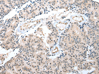 Immunohistochemistry of paraffin-embedded Human prost at e cancer tissue using S100A16 Polyclonal Antibody at dilution of 1:25 (×200)