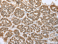 Immunohistochemistry of paraffin-embedded Human esophagus cancer tissue using ATXN7L3 Polyclonal Antibody at dilution of 1:35 (×200)